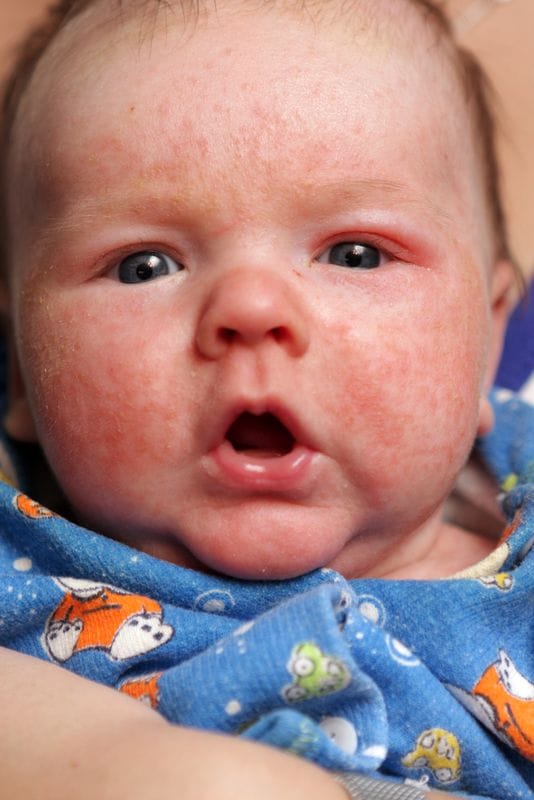 Childhood eczema and the role of food allergies and intolerances Childhood eczema and the role of food allergies and intolerances